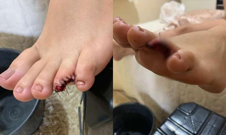 Mulher perde parte do dedo após ser atacada por peixe em praia de Itaituba
